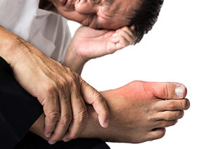 A man suffering from painful and inflamed gout on his right foot around the big toe area.