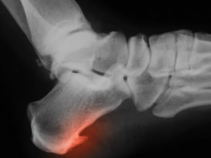 Xray of inflamed heel, glowing red.