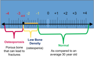 Scale of bone density from low to high and how it can impact you. It looks like a blue ruler and identifies osteoporosis and osteopenia.
