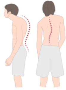 A graphic of a person with a curved spine.