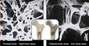 Side by side comparison of normal bone mass and low bone mass. Black and white. Low bone mass shows huge holes in the tissue.