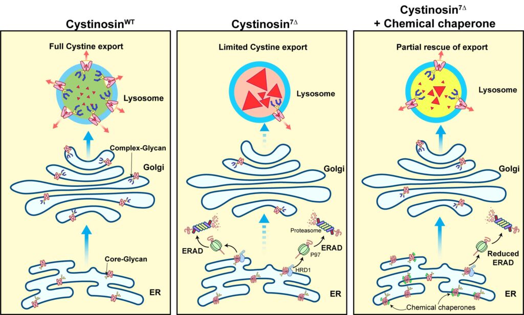 In a healthy lysosome, transporter proteins are able to move cystine, an amino acid, out of the organelle (left). In a patient afflicted with cystinosis, mutated cystine transporters are degraded by a cellular mechanism that degrades damaged proteins, called endoplasmic-reticulum-associated degradation. Consequently, the lysosome is unable to remove amino acid from the organelle, causing a build-up of cystine (center). Using a chemical chaperone also used to treat a form of cystic fibrosis, University of Michigan researchers were able to protect the mutated lysosome cystine transporter from degradation (right). The chemical chaperones aided in clearing cystine from the lysosome. Image credit: U-M Ming Lab