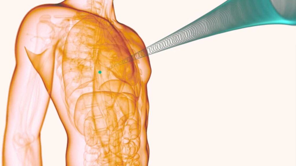 Concept illustration of Histotripsy. Image courtesy: Histotripsy Group