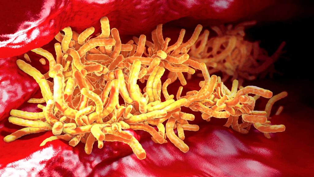 Accumulation of tuberculosis bacteria inside pulmonary tract. Image credit: iStock