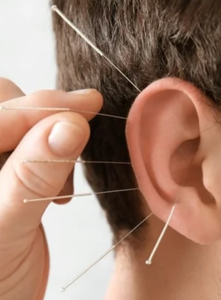 An ear with acupuncture needles