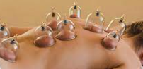 A person lays face down with acupuncture cups placed all over their back.