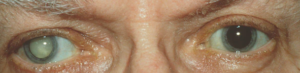 Close-up of eyeball with cataract.