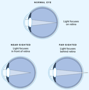 Graphic of three eyeballs with different conditions.