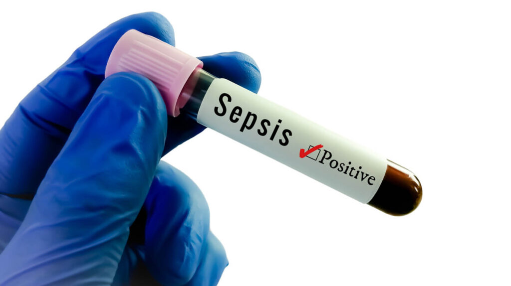 Blood sample for Sepsis test. Image credit: iStock