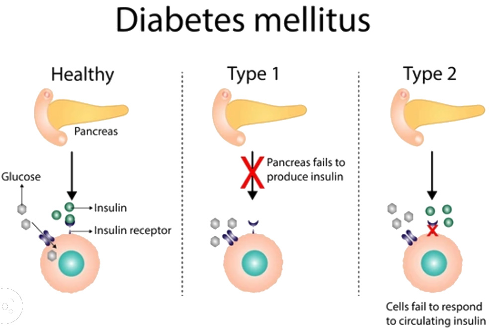 A graphic showing how the pancreas operates and how diabetes manifests.