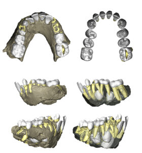 3D renderings of the juvenile mandible. The teeth on the right side are the permanent teeth. Image credit: Anna Ragni
