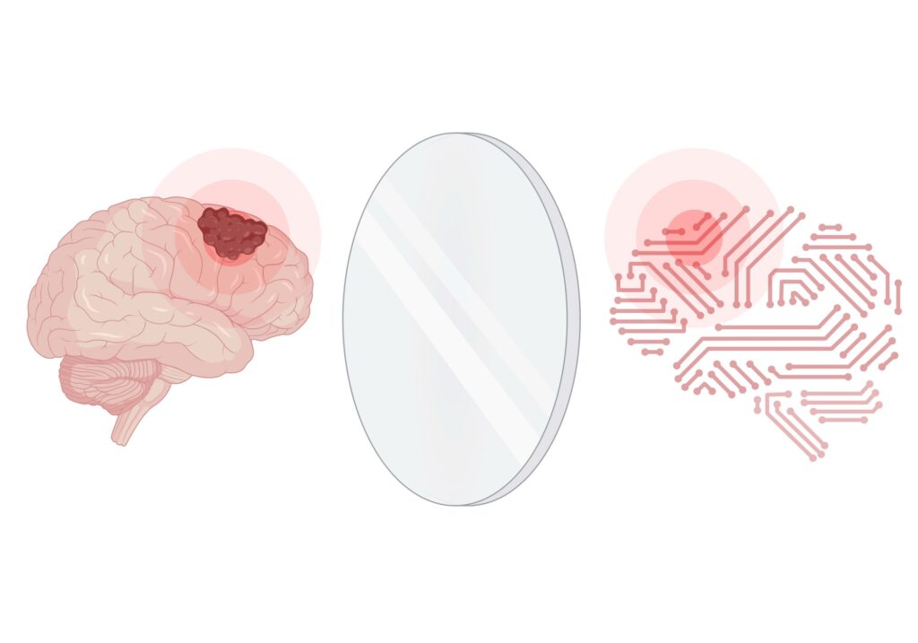 Left: a brain in the style of a medical illustration with the tumor in the frontal cortex. Right: The mirror image of the brain in a 'digital' illustration style contains a tumor in the same spot. A glass-like oval sits between them.